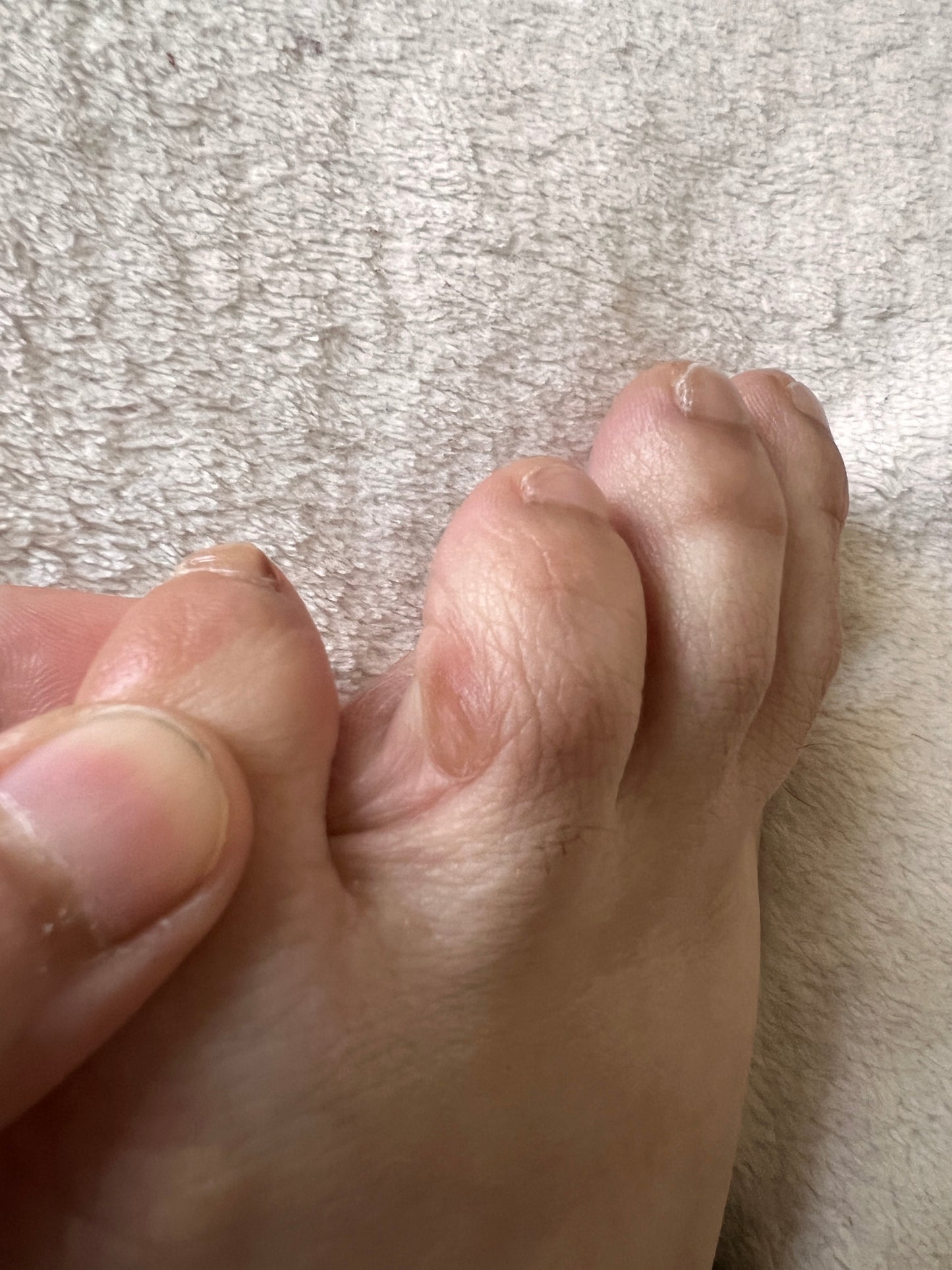 SILICONE ANTI-FRICTION TOE PROTECTOR